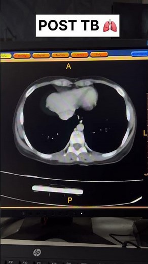 Post TB RUL Collapse CT with Bronchiectasis #shorts