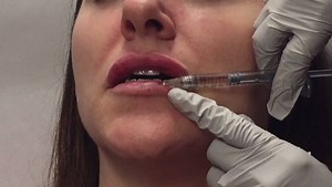 #Juvéderm in action! A slow and steady injection is key to creating the desired look. 💋 Learn more about Juvéderm and our other fillers here: http://bit.ly/fb_juvederminfo | Ideal Image