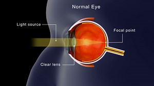 Biomedical Animation Of Cataracts In Human Stock Motion Graphics SBV-348849245 - Storyblocks