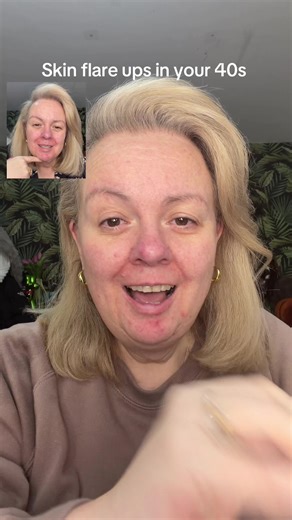 Managing Periderma Dermatitis in Your 40s