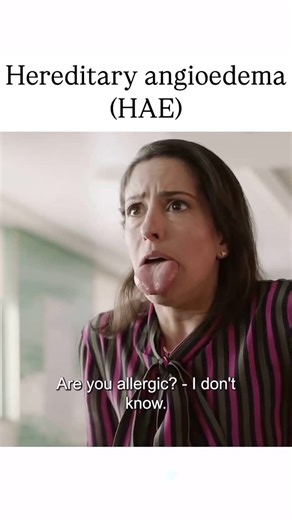 Medical insightX😷 on Instagram: "Hereditary angioedema (HAE) is a disorder that results in recurrent attacks of severe swelling.[3] The swelling most commonly affects the arms, legs, face, intestinal tract, and airway.[3] If the intestinal tract is affected, abdominal pain and vomiting may occur.[1] Swelling of the airway can result in its obstruction and trouble breathing.[1] Without preventive treatment, attacks typically occur every two weeks and last for a few days. #hereditaryangioedema #s