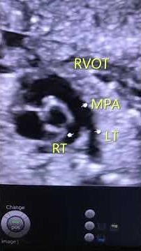LVOT RVOT