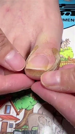 Say Goodbye to Ingrown Toenails with These Simple Stickers( # 2609 ) 1️⃣