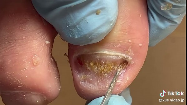 Understanding Blackened Toenails and Their Causes