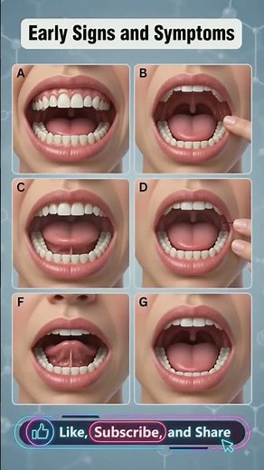 Tongue Cancer Early Signs | Oral Cancer Symptoms Explained | Mouth Cancer Warning Signs | #shorts