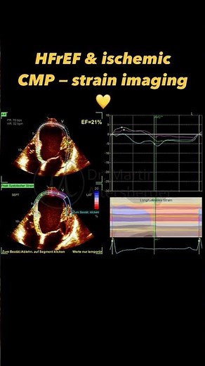 HFrEF & #heartfailure in #echocardiography - strain imaging