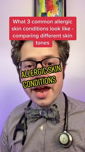 Here are three of some of the most common allergic skin conditions and how it can appear differently based on lighter versus darker skin tones. #allergies #skin #rash #tiktokdoc #learnontiktok