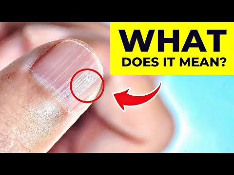 What Do Vertical Ridges On Your Nails Mean? The REAL Cause!