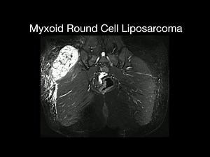 Myxoid Round Cell Liposarcoma