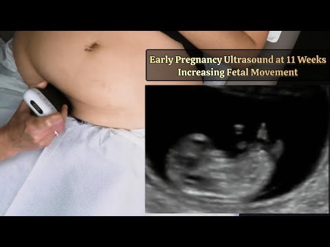 Early Pregnancy Ultrasound at 11 Weeks | Rapid Growth (Early Fetal Movement)
