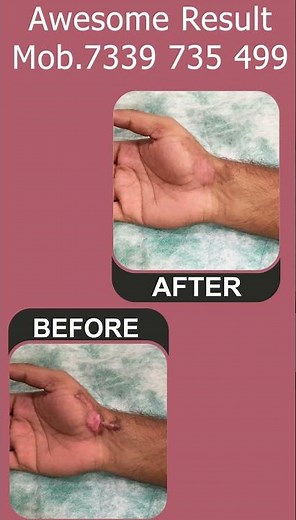 Keloid Treatment at Skinaa Clinic