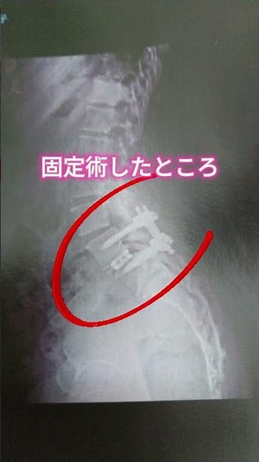 腰椎後方錐体間固定術（私がやった手術）＃手術＃腰椎＃脊椎＃固定術＃整形＃麻酔