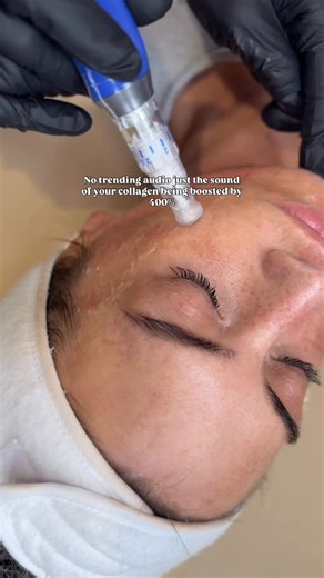 Midlands | Nurse Led Aesthetics | Skin | Tazmin Homer on Instagram: "The sweet sound of collagen production 😏😍 Improve dullness, reduce fine lines, repair uneven texture.. Think of it as a winter skin reset that’ll have you glowing by spring. 🫶🏻 To book please visit the link in my bio #skinpen #collagen #labelleaesthetics #microneedling #asmr"