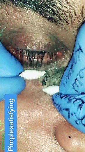 Episode 10| Deep black dot under eye 👁 #pimplepopper #puntosnegros #pimplepop #pimple