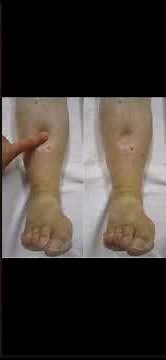 Lasix(Furosemide Injection +Tablet) Use For what