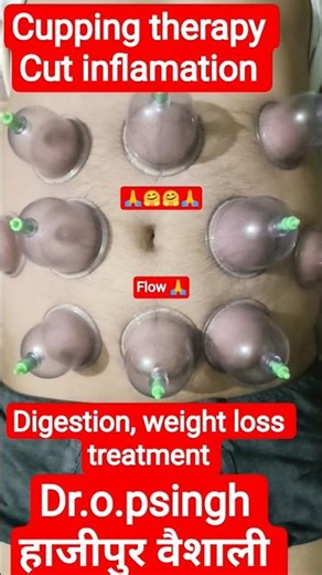 Cupping therapy | Cut inflamation | Digestion problem | weight loss treatment #cupping #trending