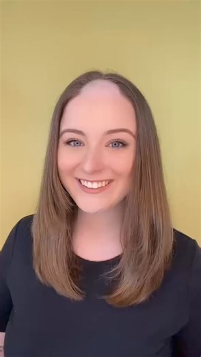 34K views · 115 reactions | Perfection in just minutes!!! This lovely girl is wearing UniWigs full lace base hairline patch in 210 truffle brown shade. Comment PATCH if you want a direct link! #UniWigs #hairpatch #hairtransformation #pullinghair #humanhairwigs #baldspots #hairlosssolution #hairloss #alopeciaareata #frontalfibrosingalopecia #thinninghairsolution #alopecia #hairstyles #haarausfalllösung #hairlossjourney | UniWigs | Facebook