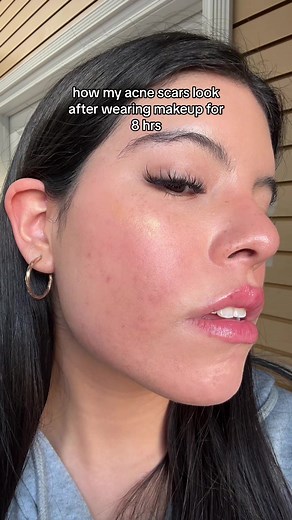 Top Recommendations for Acne-Fighting Foundation