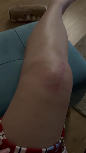 Knee Replacement Recovery Tips for Overcoming Pain