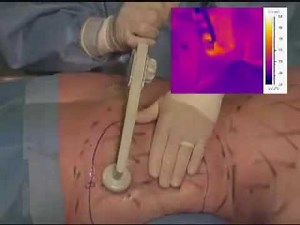 BodyTite Liposuction Skin Tightening Demonstration on Female Patient.flv