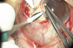 Lentes Intraoculares Suturada a Sulcus | Visioncore Clínica