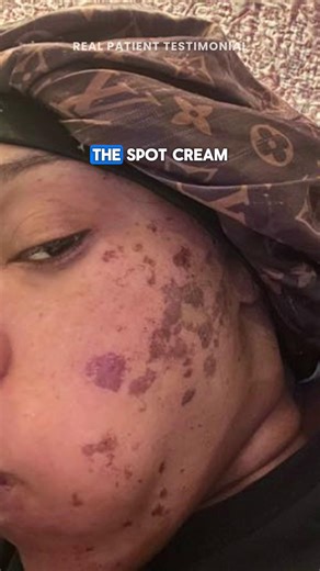 Results like these say it all. Bringing back our patients’ confidence is the best part! ❤️ The Spot Cream has helped changed thousands of lives by erasing stubborn dark spots and revealing the clear complexion you’ve been wishing for ✨ | Musely
