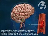 Transient Ischemic Attack (TIA) • Video • MEDtube.net