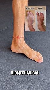 Your bunion and collapsed foot aren’t things you were born with, but rather something your biomechanical behavior picked up, maybe from a young age. It’s a misaligned use of your toes, feet, hips, pelvis, and core. All of these together create the symptoms of the bunion or flat foot. To fix the situation and bring yourself back to balance, you need to practice a unique set of exercises in a dedicated way. With time and effort, you’ll notice that you’re growing in a better and more aligned direct