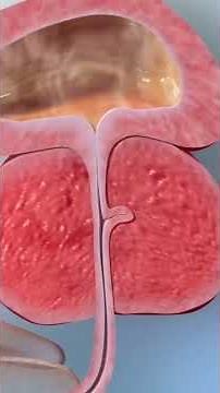 Discover the benefits of HoLEP for treating BPH!