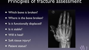 Current Concepts in the Fixation of Fractures of the PIPJ and DIPJ