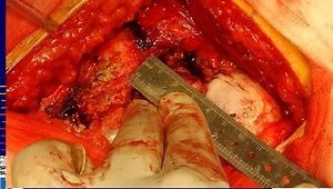 Proper Reaming and Cup Positioning in Primary Total Hip Replacement