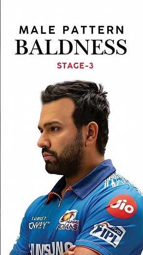 Here’s What Each Hair Loss Stage Looks Like | Rohit Sharma Baldness Pattern Stages Version