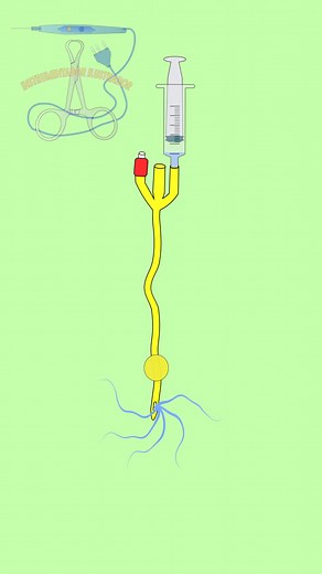 Sonda Foley de Tres Vías: Funciones y Técnicas