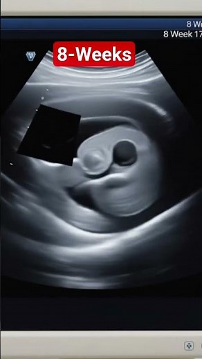 8-weeks Pregnancy Ultrasound Scan | Is It Twins?