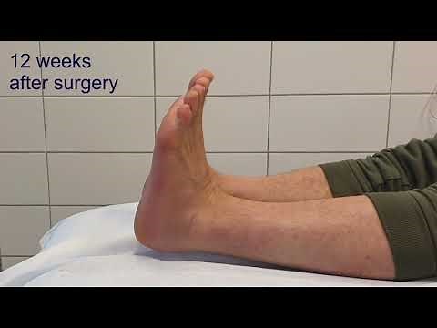 calcaneus fracture comminuted Sanders 4 _ minimal invasive surgery _ clinical course