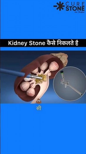 Pcnl animation | How pcnl is done | kidney stone treatment animation