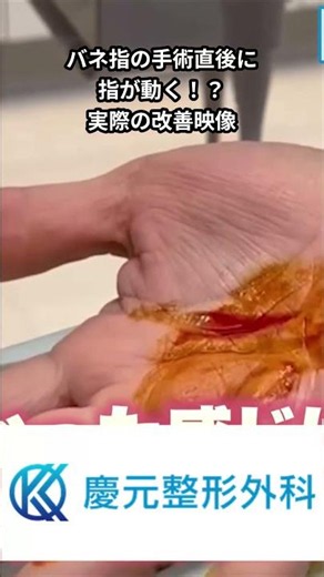 【衝撃】バネ指の手術直後に指が動く！？実際の改善映像
