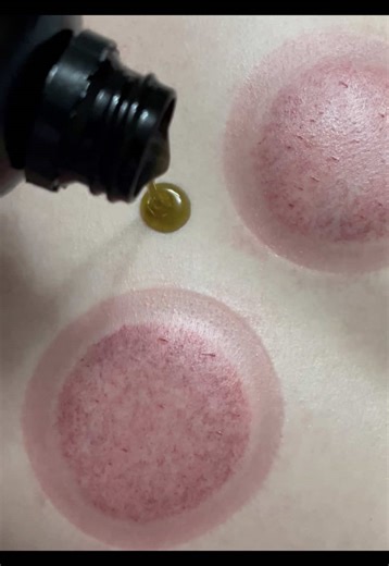 Hijama isn't just a remedy, it's a powerful medical treatment done by the Prophet Muhammad ﷺ rooted in both tradition and science. It works beneath the surface, drawing out toxins, improving circulation, and restoring balance in the body. #hijama #cupping #hadith #fyp #islam