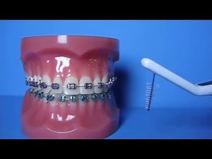 Getting started with Braces: Your complete guide to oral hygiene.