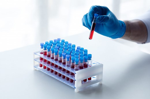 Dosage de l'antigène carcino-embryonnaire (ACE) : normes