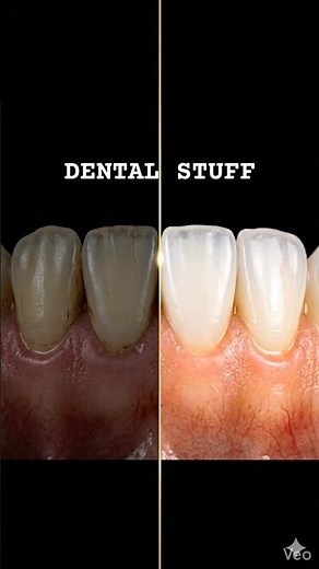 Dental veneers procedure step by step by dental stuff #dentalveneers #veneers #dentist