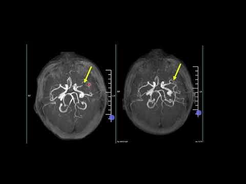 Understanding Arterial Spin labeling MR Perfusion and ADC Reversal