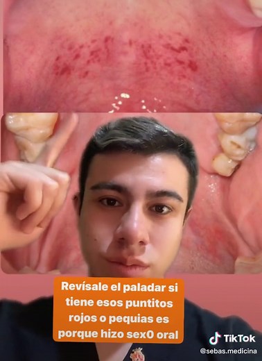 Heridas y Manchas en el Paladar: Causas Comunes