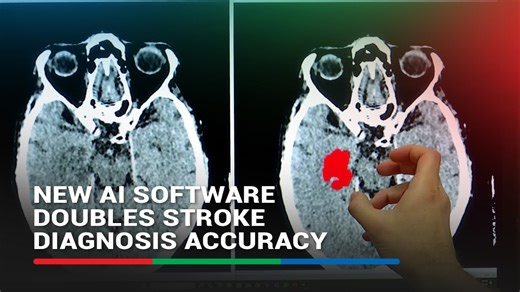 99K views · 1K reactions | New AI software can read the brain scans of patients who have had a stroke to more accurately determine the timing of the stroke and assist physicians in deciding if it can be effectively treated. Link to full story in the comments section. | ABS-CBN News | Facebook