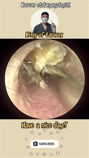 Effective Earwax Removal Techniques You Need to Know