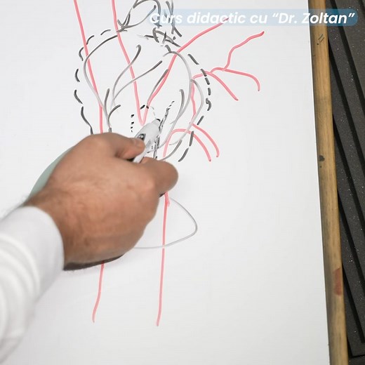 ❤️ O operație pretențioasă: tumora de glomus carotidian. Atașat găsiți și un mic curs didactic pentru cei interesați. 👉 Notă: am păstrat clasificarea Shamblin pentru tumorile glomice (1,2,3,3b) introducând în plus stadiul 4 pentru tumorile glomice ce au depășit deja bifurcația carotidei ca și cea din cazul prezentat mai jos Echipa Cardionet ❤️ | Dr. Zoltan Galajda - Cardionet Hospital