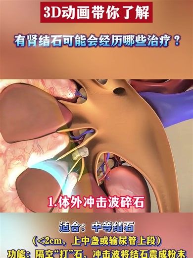 3D动画带你了解有肾结石会经过哪些治疗!