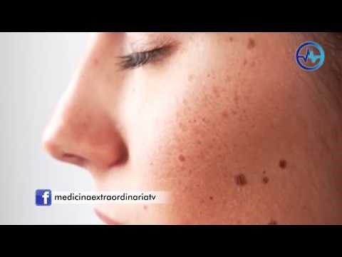 Laser Mole Removal - Eternal Youth Medical Aesthetic Center