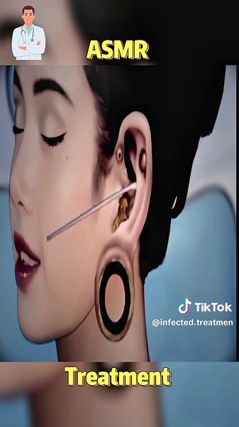 Noise and Ear Treatment Asmr #infect #faceinfection #virlditiktok #asmrvideo #ukdoctor