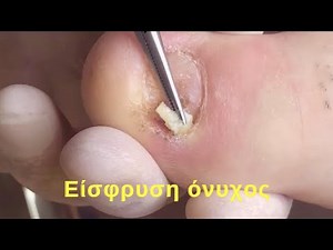 ΕΙΣΦΡΥΣΗ ΟΝΥΧΟΣ | ΝΥΧΙ ΠΟΥ ΜΠΑΙΝΕΙ ΣΤΟ ΔΕΡΜΑ | ΠΟΝΟΣ | ΟΝΥΧΟΚΡΥΠΤΩΣΗ | INGROWN TOENAIL | PAIN